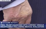 Main image for What to Know About Trump's Chronic Venous Insufficiency Diagnosis. 