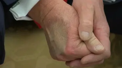 אלעס ארום טראמפ'ס כראנישע דיאגנאז